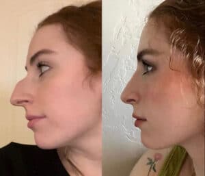 rhinoplasty confidence