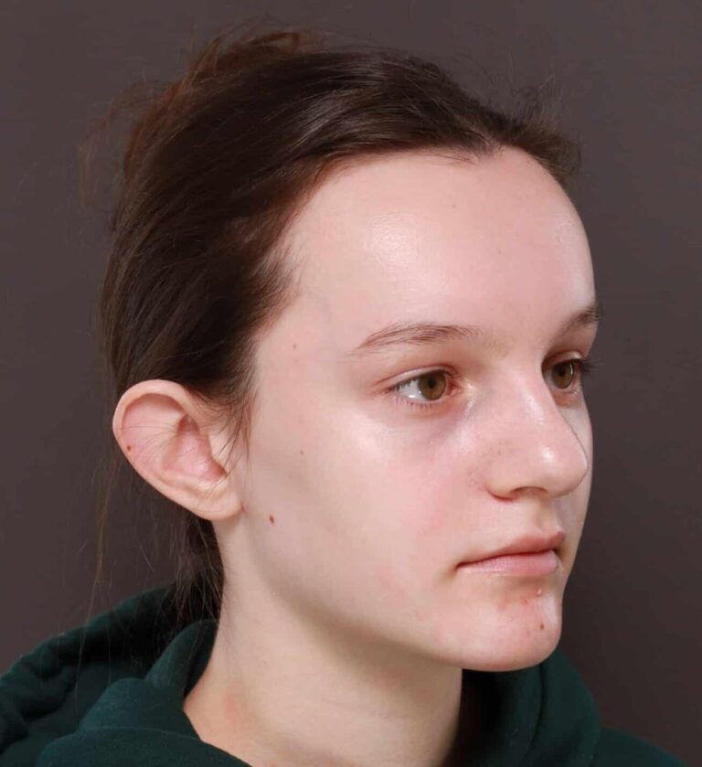 Before Image: Otoplasty by Dr. Thompson - right-front-oblique