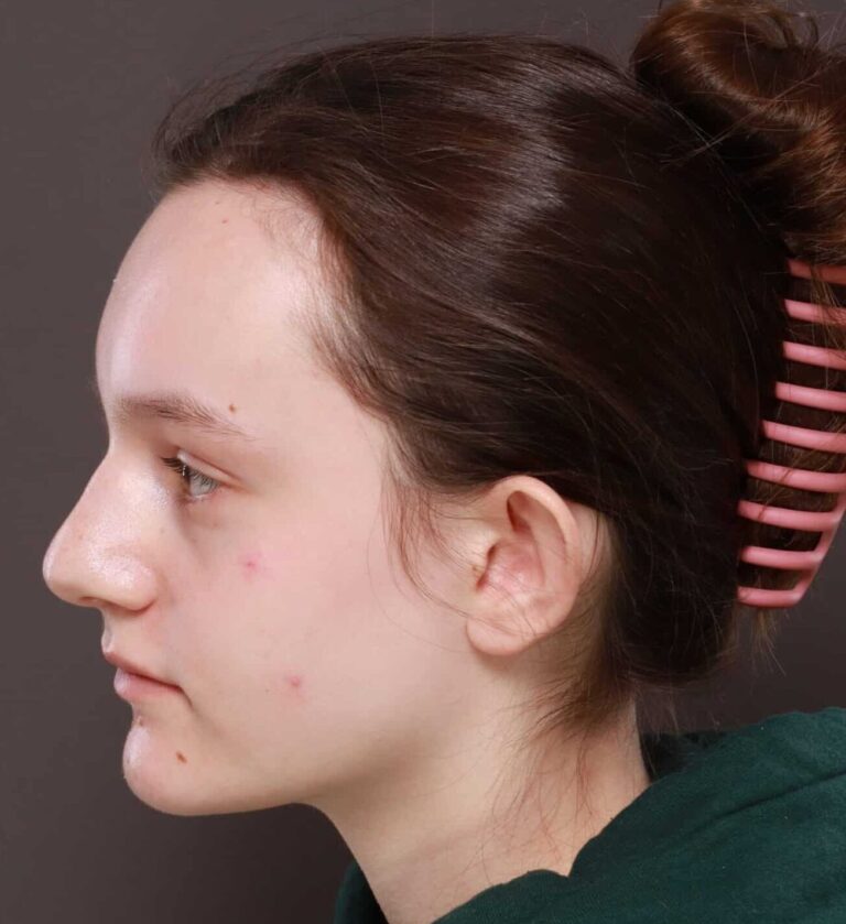 Before Image: Otoplasty by Dr. Thompson - left-side