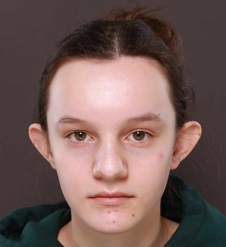 Before Image: Otoplasty by Dr. Thompson - front