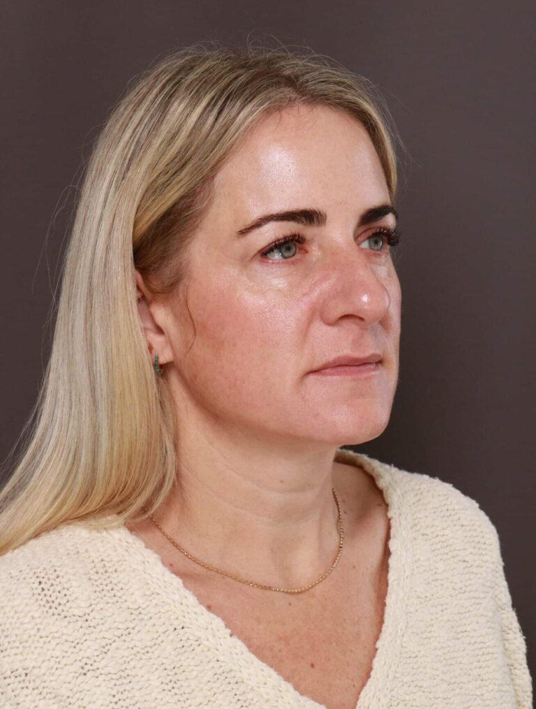 Before Image: Upper Blepharoplasty by Dr. Henstrom - right-front-oblique