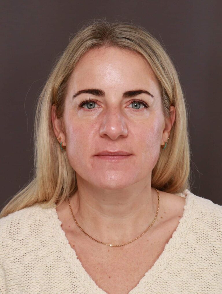 Before Image: Upper Blepharoplasty by Dr. Henstrom - front