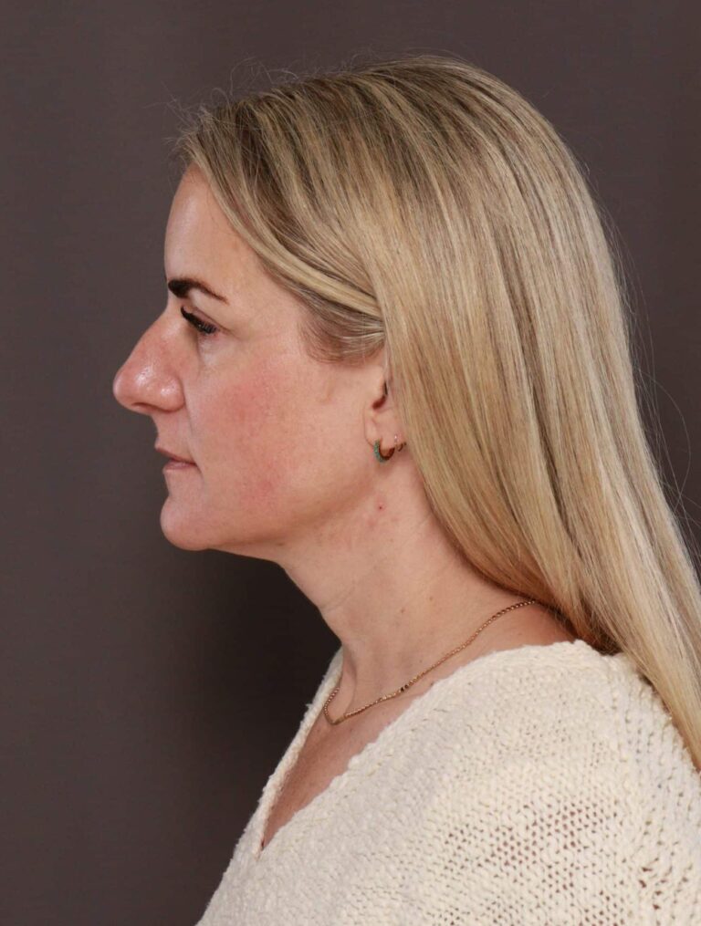 Before Image: Upper Blepharoplasty by Dr. Henstrom - left-side