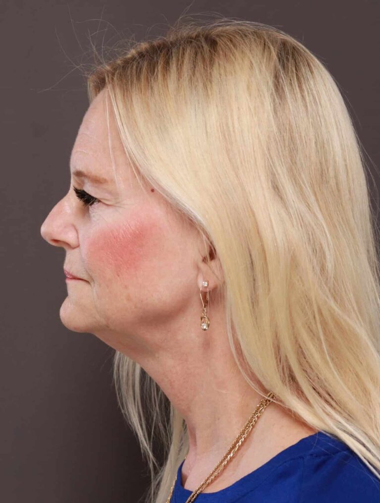 Before Image: Facelift, Browlift, & Upper Blepharoplasty by Dr. Thompson - left-side