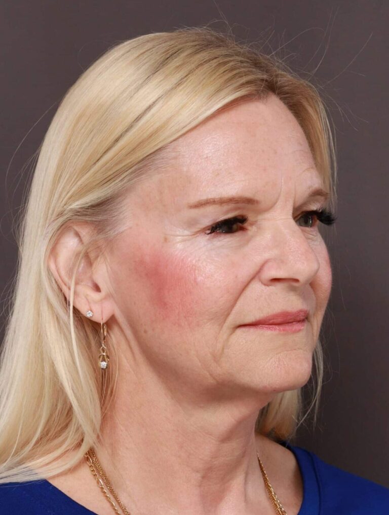 Before Image: Facelift, Browlift, & Upper Blepharoplasty by Dr. Thompson - right-front-oblique