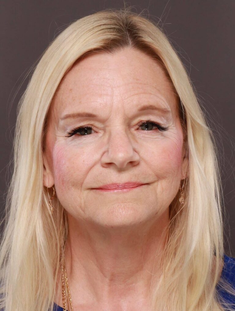 Before Image: Facelift, Browlift, & Upper Blepharoplasty by Dr. Thompson - front