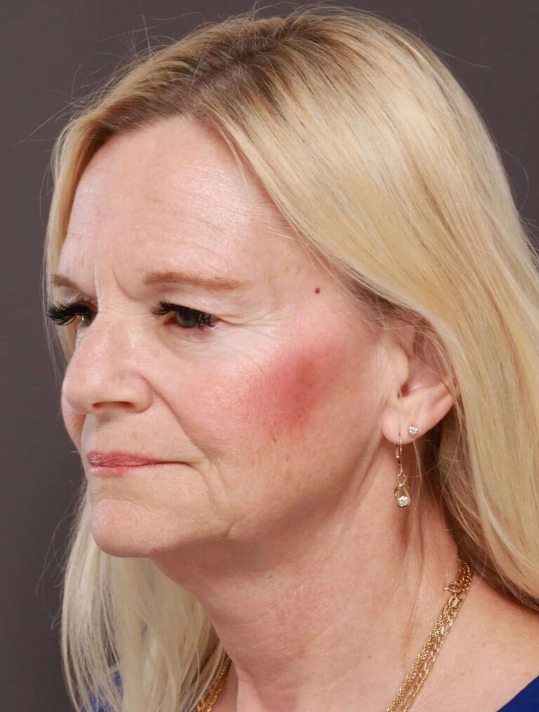 Before Image: Facelift, Browlift, & Upper Blepharoplasty by Dr. Thompson - left-front-oblique