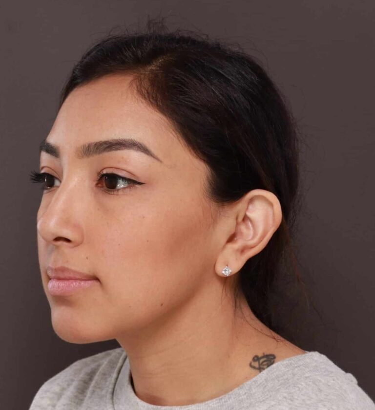 Before Image: Otoplasty & Earlobe Reduction by Dr. Henstrom - left-front-oblique
