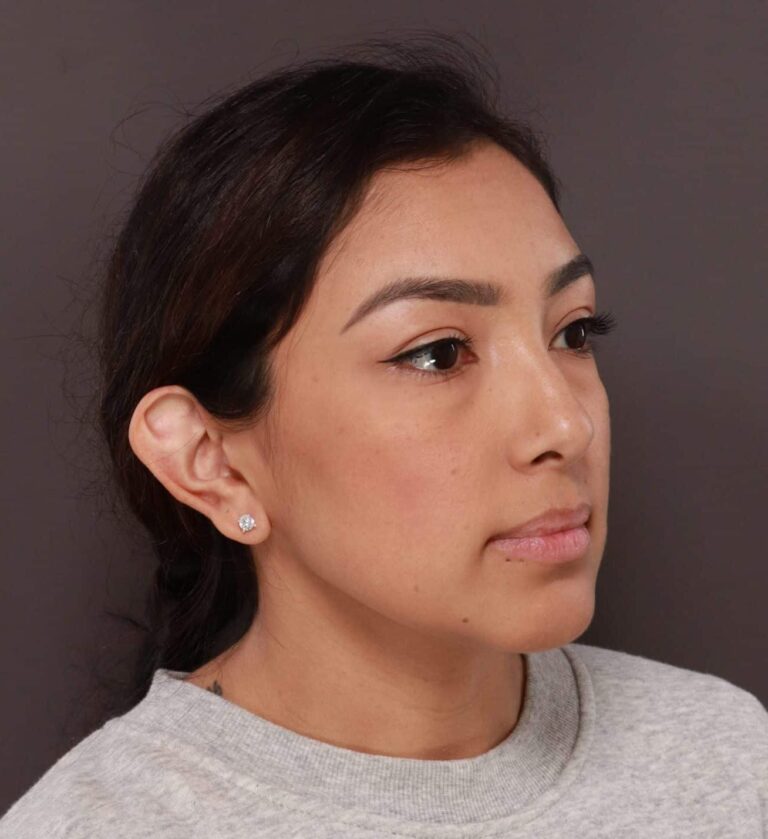 Before Image: Otoplasty & Earlobe Reduction by Dr. Henstrom -