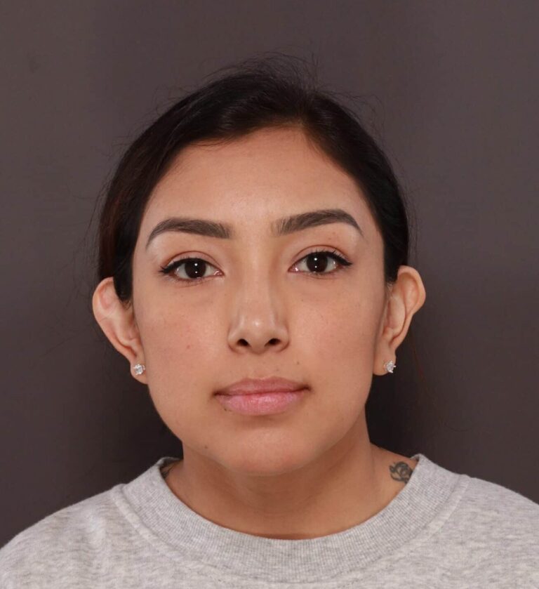 Before Image: Otoplasty & Earlobe Reduction by Dr. Henstrom - front