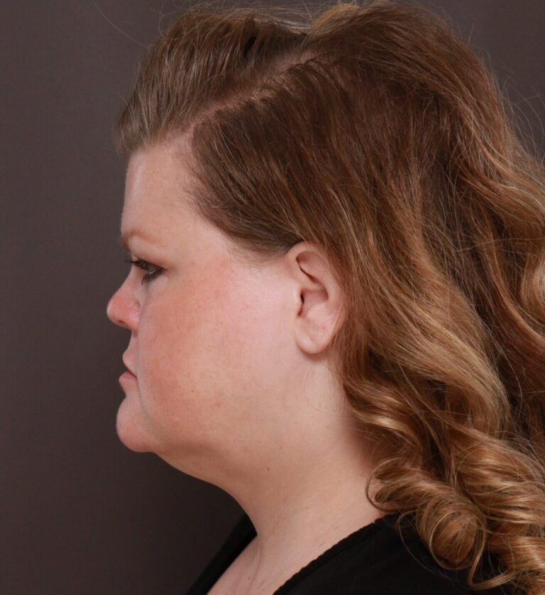 Before Image: MACSlift and Upper Blepharoplasty by Dr. Henstrom - left-side