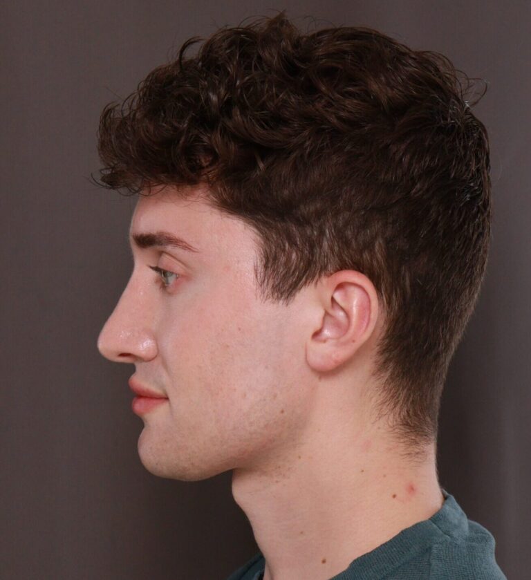 After Image: Rhinoplasty by Dr. Henstrom - left-side