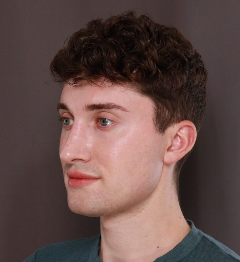 After Image: Rhinoplasty by Dr. Henstrom - left-front-oblique