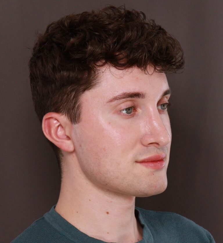 After Image: Rhinoplasty by Dr. Henstrom - right-front-oblique