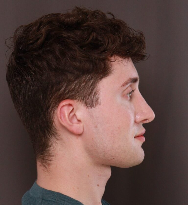 After Image: Rhinoplasty by Dr. Henstrom - right-side