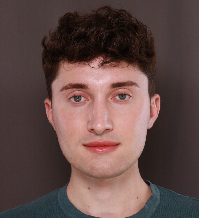 After Image: Rhinoplasty by Dr. Henstrom - front