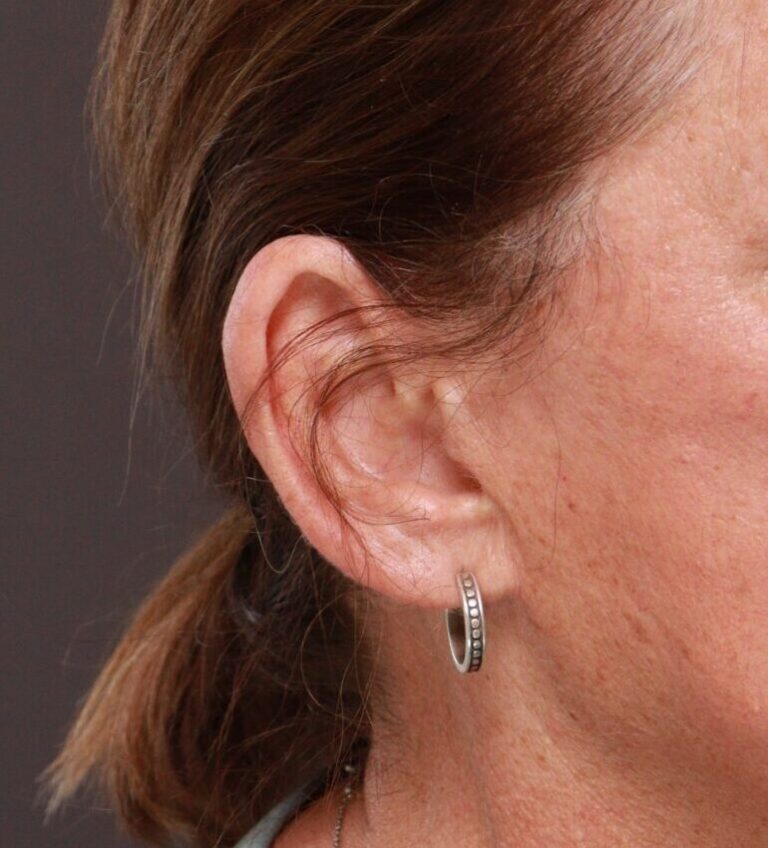 After Image: Earlobe Reduction by Dr. Thompson -