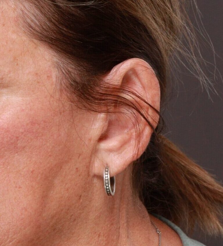 After Image: Earlobe Reduction by Dr. Thompson - left-front-oblique