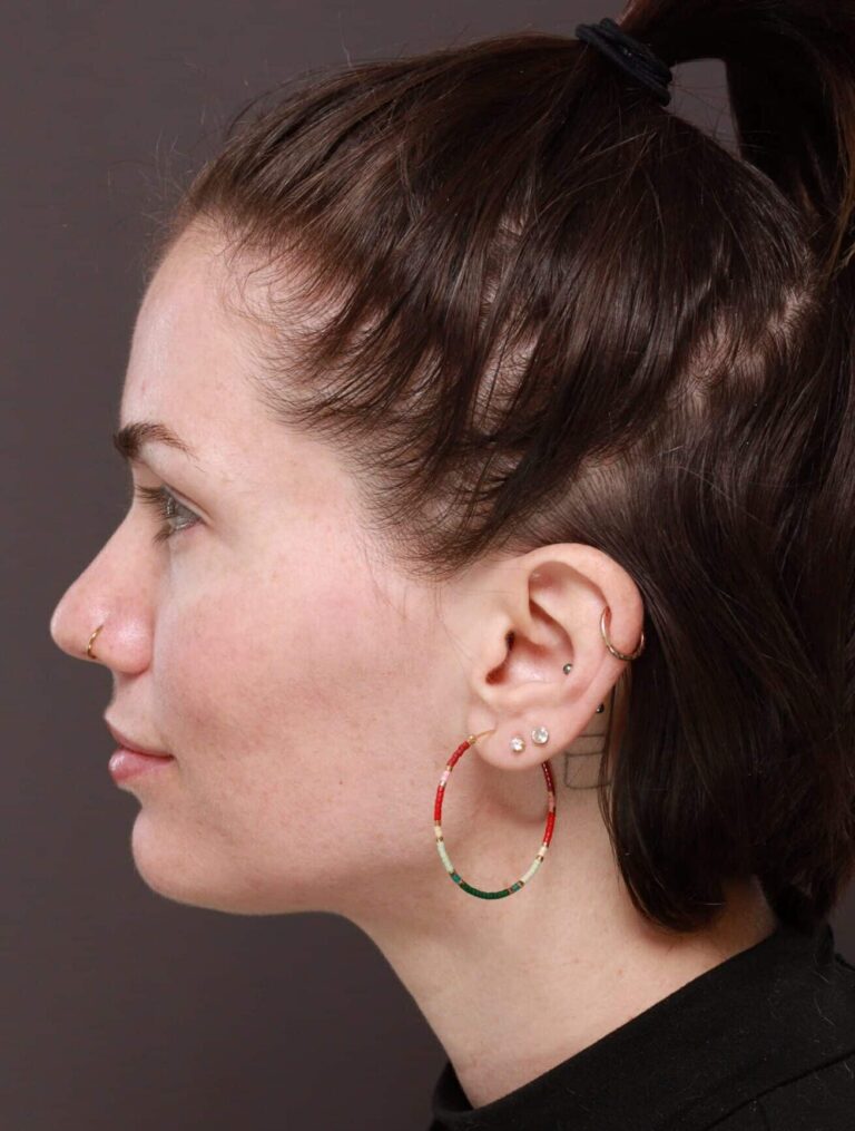 Before Image: Moxi Laser Resurfacing - left-side
