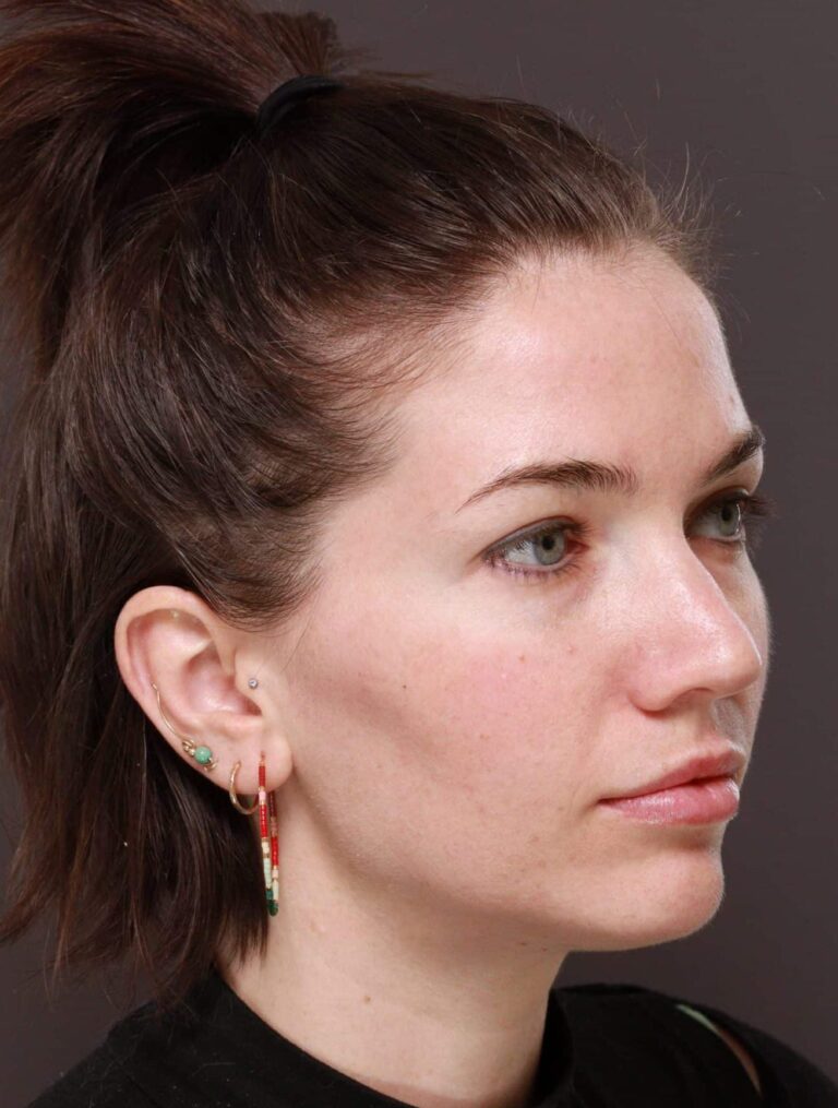 Before Image: Moxi Laser Resurfacing - right-front-oblique