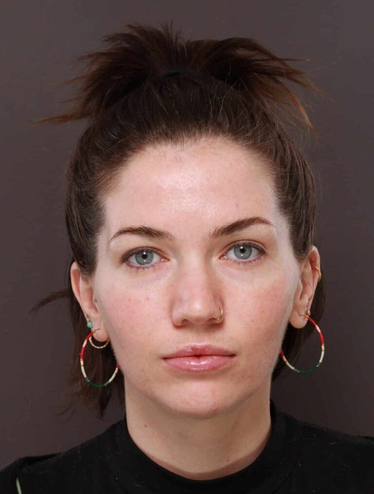 Before Image: Moxi Laser Resurfacing - front