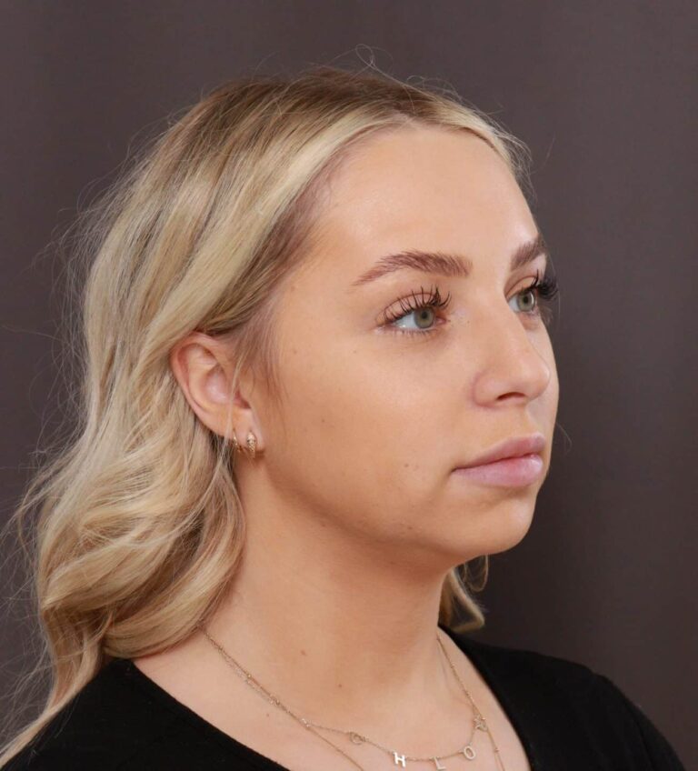 Before Image: Rhinoplasty by Dr. Henstrom - right-front-oblique