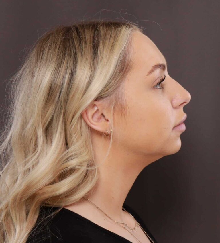 Before Image: Rhinoplasty by Dr. Henstrom - right-side