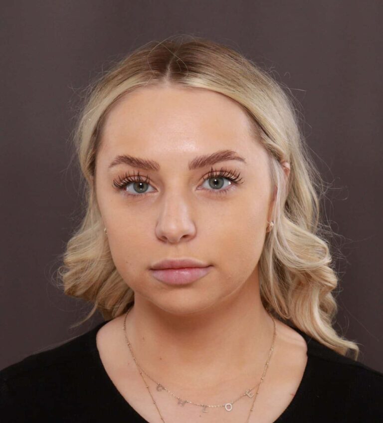 Before Image: Rhinoplasty by Dr. Henstrom - front