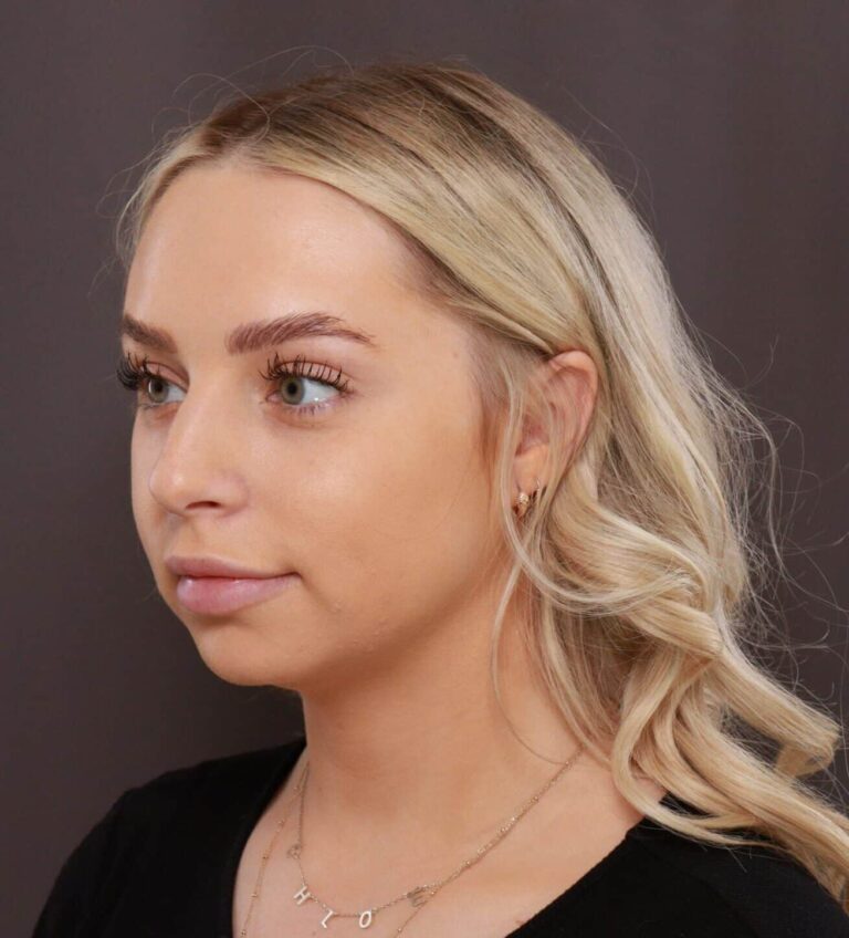 Before Image: Rhinoplasty by Dr. Henstrom - left-front-oblique