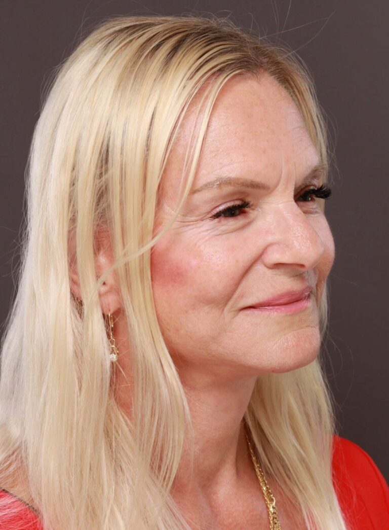 After Image: Facelift, Browlift, & Upper Blepharoplasty by Dr. Thompson - right-front-oblique