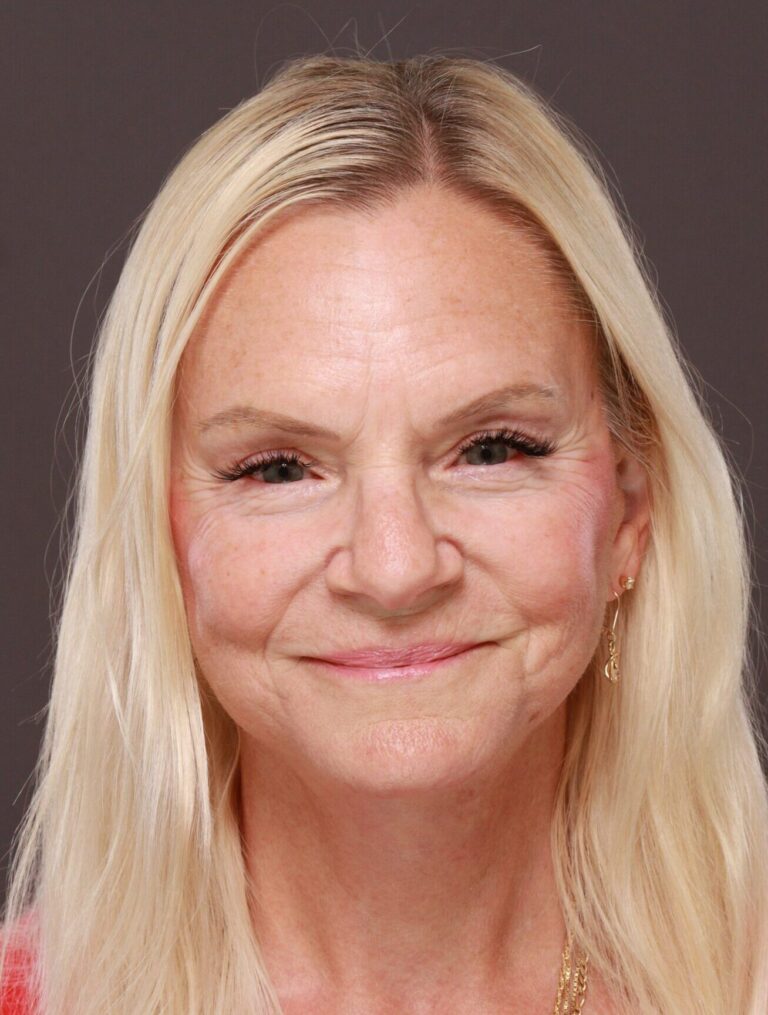 After Image: Facelift, Browlift, & Upper Blepharoplasty by Dr. Thompson - front