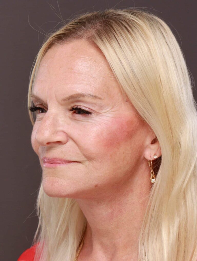 After Image: Facelift, Browlift, & Upper Blepharoplasty by Dr. Thompson - left-front-oblique
