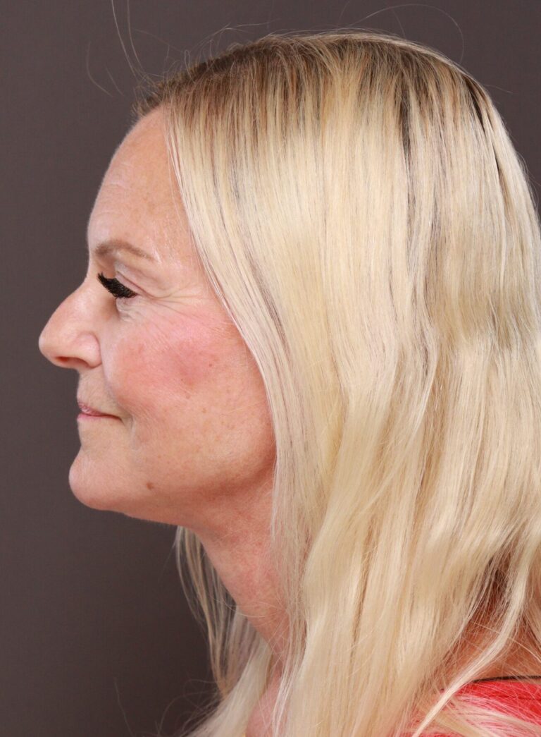 After Image: Facelift, Browlift, & Upper Blepharoplasty by Dr. Thompson - left-side