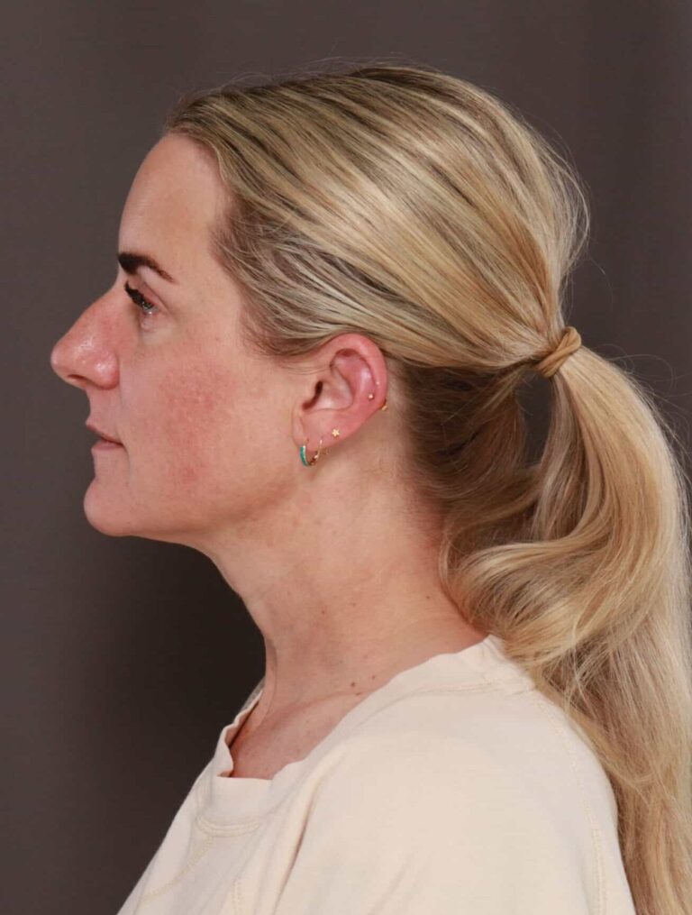 After Image: Upper Blepharoplasty by Dr. Henstrom - left-side