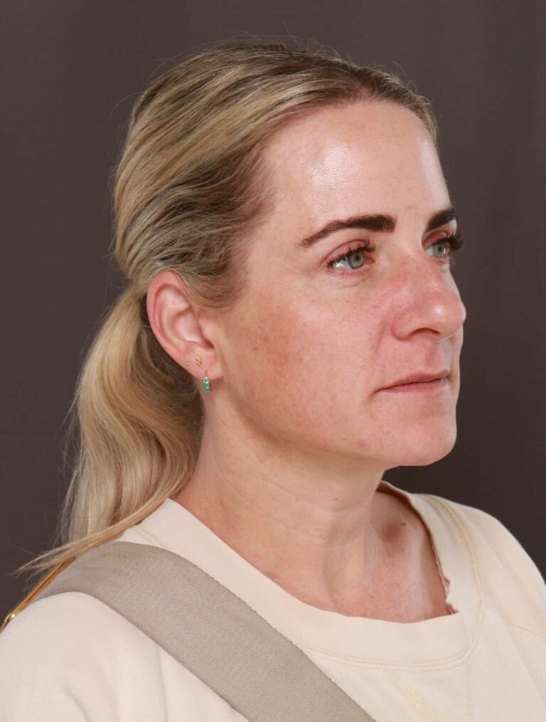 After Image: Upper Blepharoplasty by Dr. Henstrom - right-front-oblique