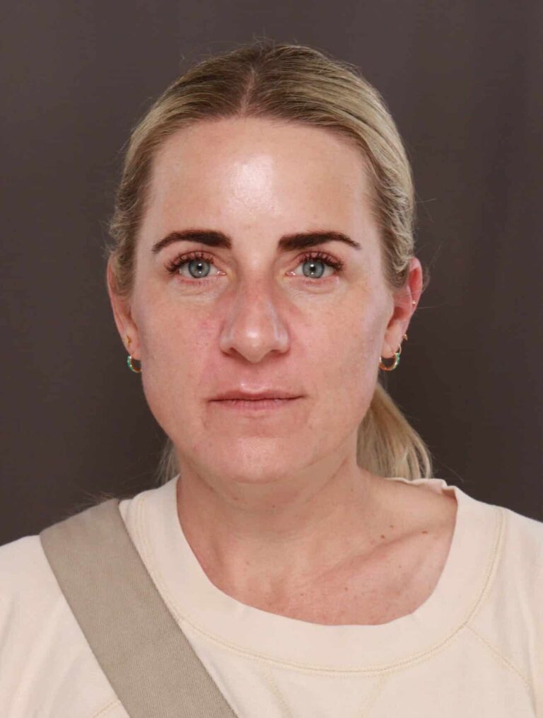 After Image: Upper Blepharoplasty by Dr. Henstrom - front