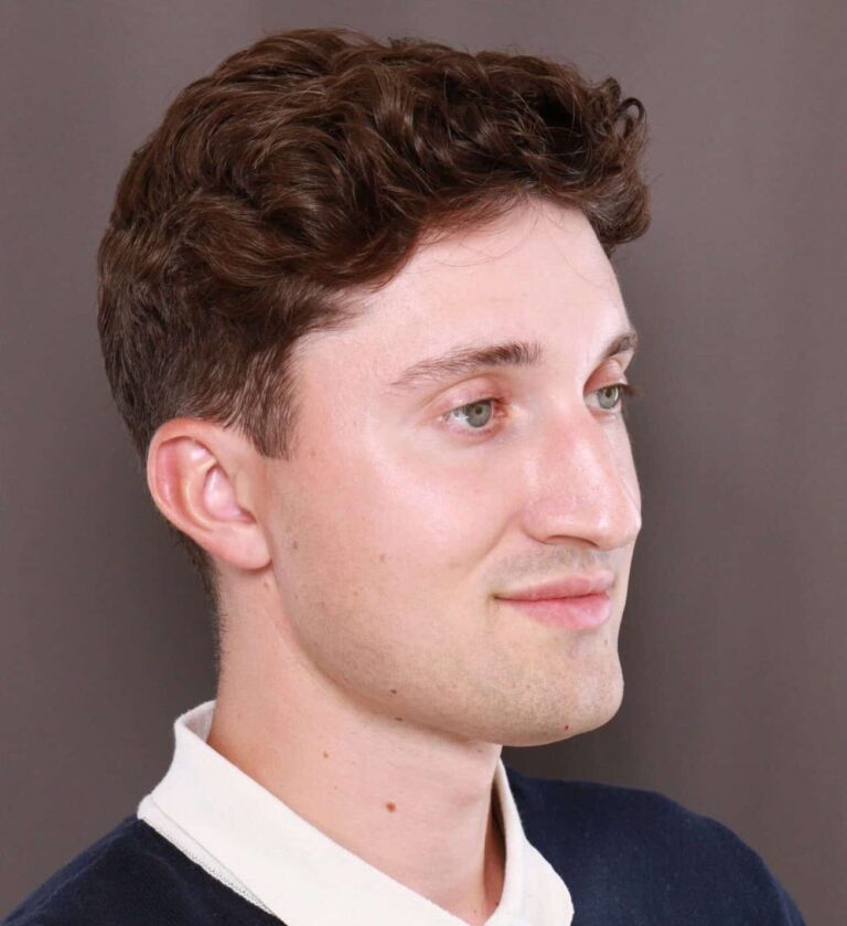 Before Image: Rhinoplasty by Dr. Henstrom - right-front-oblique