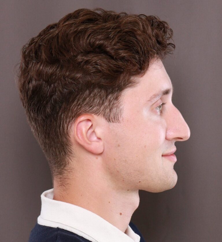 Before Image: Rhinoplasty by Dr. Henstrom - right-side