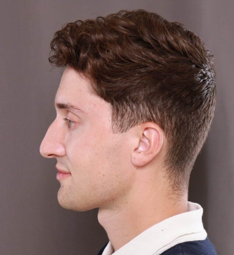 Before Image: Rhinoplasty by Dr. Henstrom - left-side