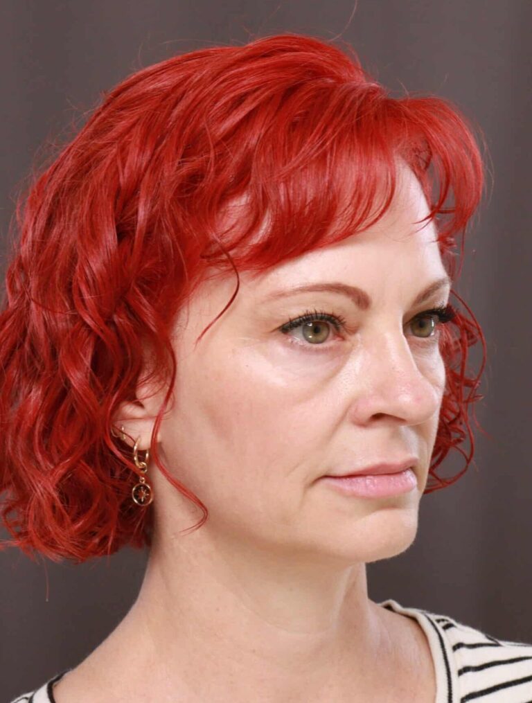 Before Image: Lower Blepharoplasty with Fat Grafting by Dr. Henstrom - right-front-oblique