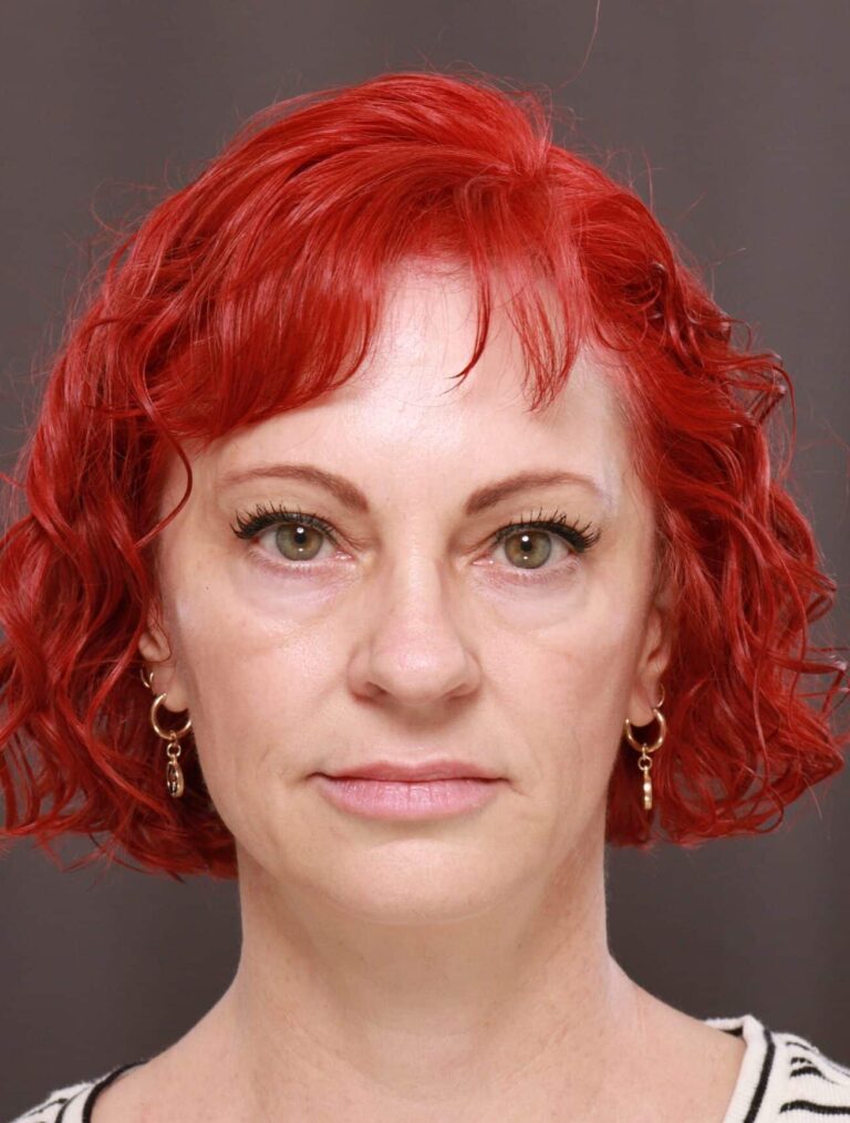 Before Image: Lower Blepharoplasty with Fat Grafting by Dr. Henstrom - front