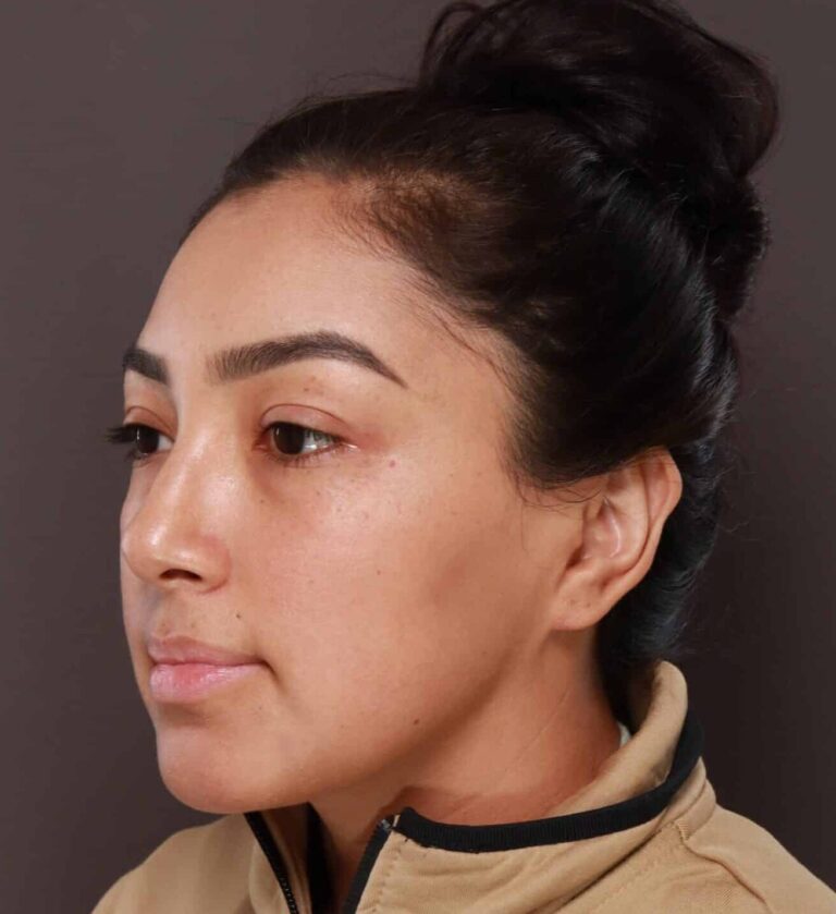 After Image: Otoplasty & Earlobe Reduction by Dr. Henstrom - left-front-oblique