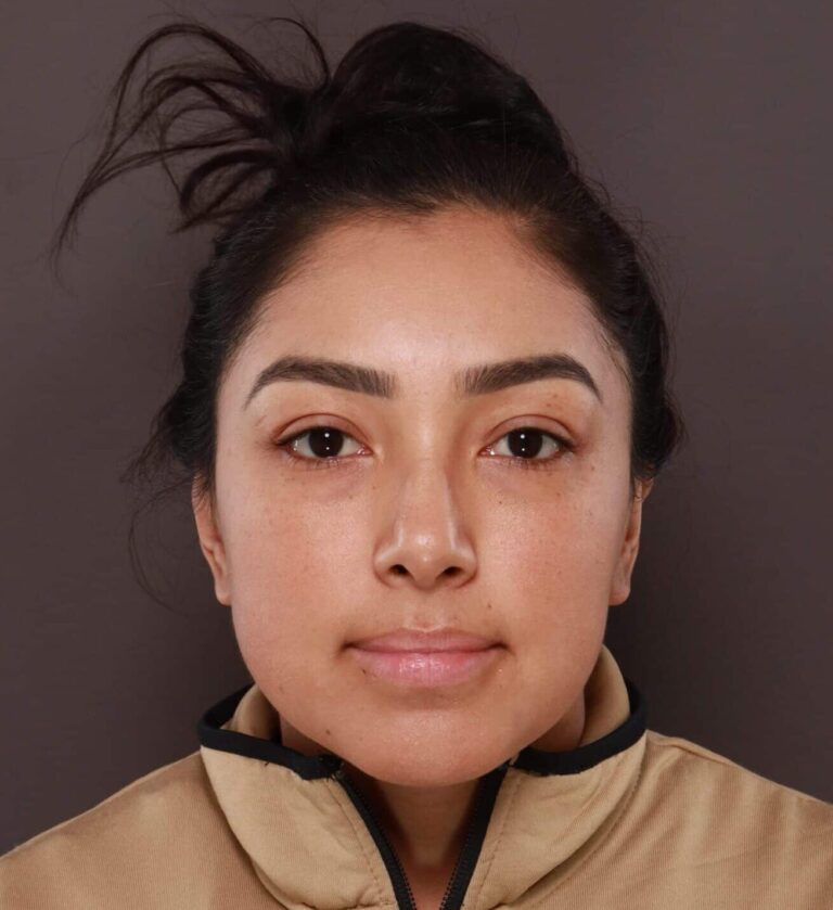 After Image: Otoplasty & Earlobe Reduction by Dr. Henstrom - front