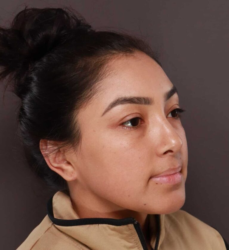 After Image: Otoplasty & Earlobe Reduction by Dr. Henstrom -