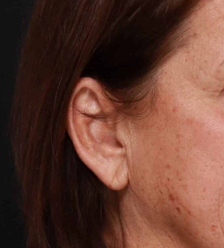 Before Image: Earlobe Reduction by Dr. Thompson -