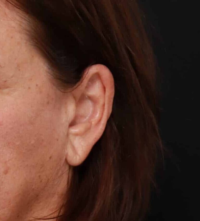 Before Image: Earlobe Reduction by Dr. Thompson - left-front-oblique