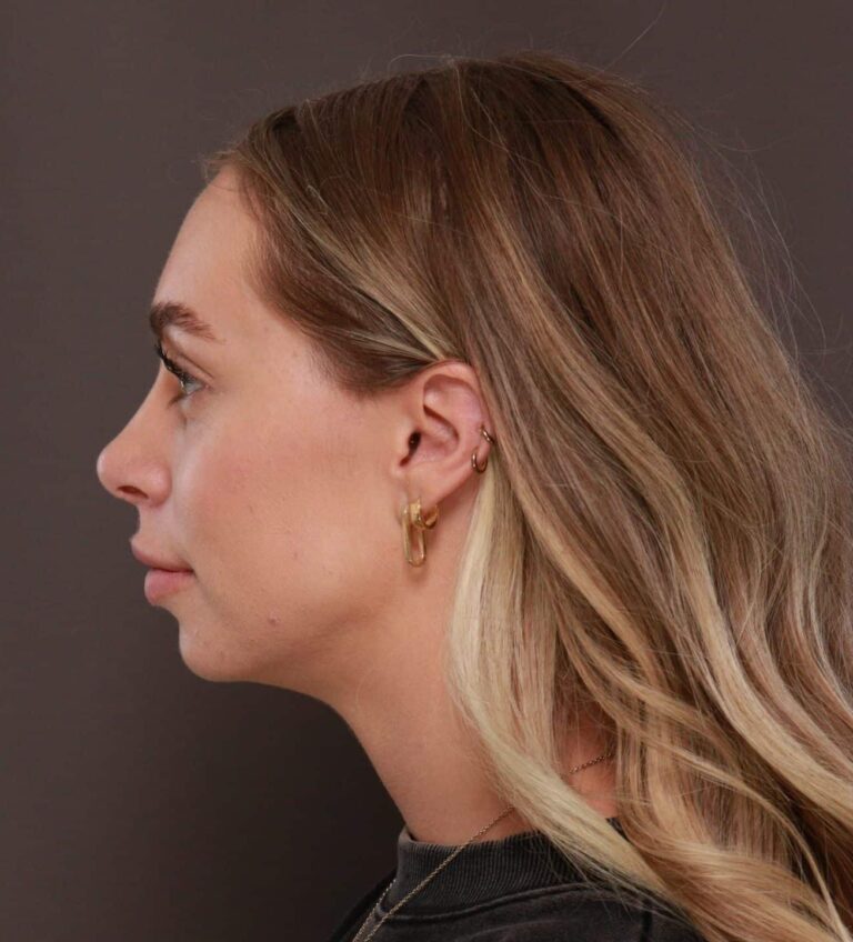 After Image: Rhinoplasty by Dr. Henstrom - left-side