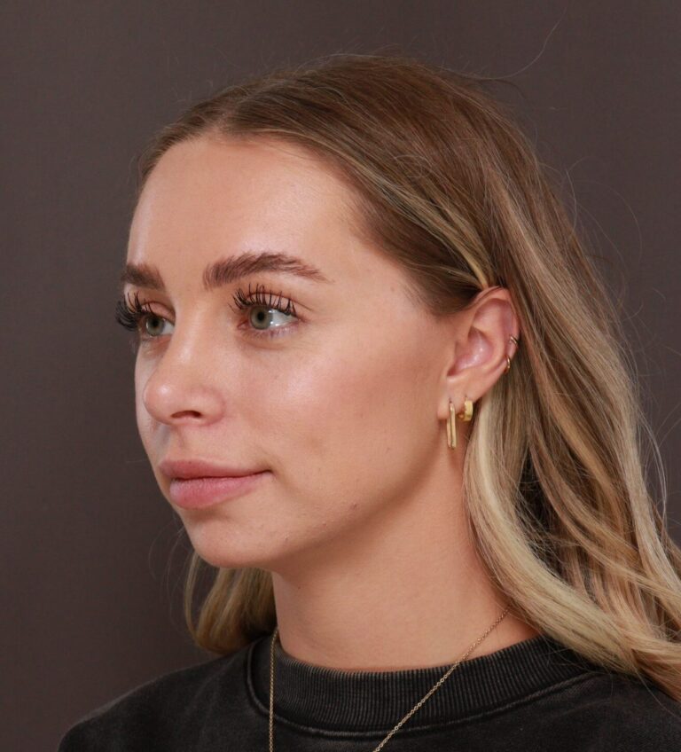 After Image: Rhinoplasty by Dr. Henstrom - left-front-oblique