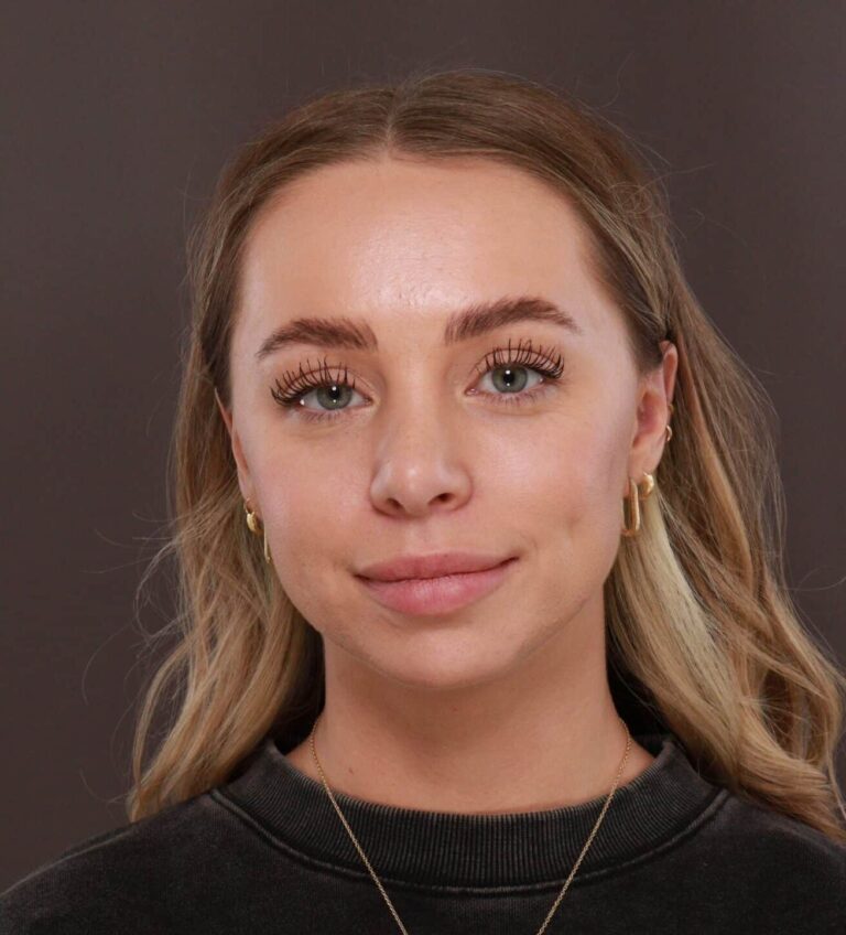 After Image: Rhinoplasty by Dr. Henstrom - front