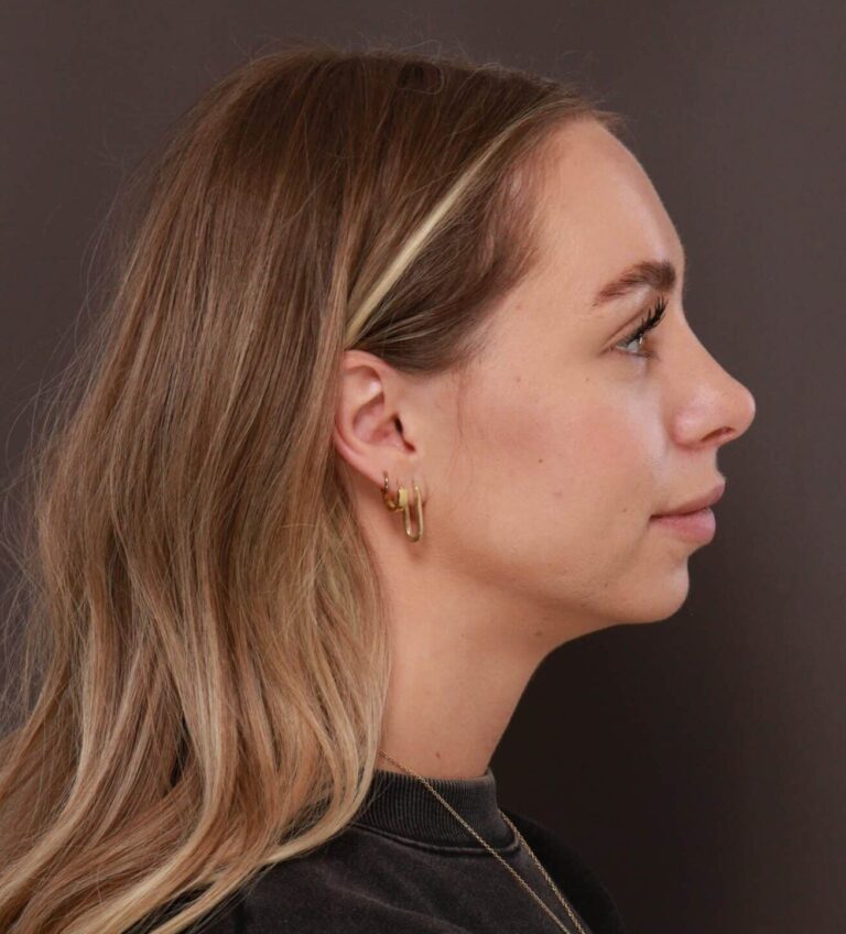 After Image: Rhinoplasty by Dr. Henstrom - right-side
